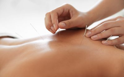 Acupuncture | Should you Consider this Treatment Option?