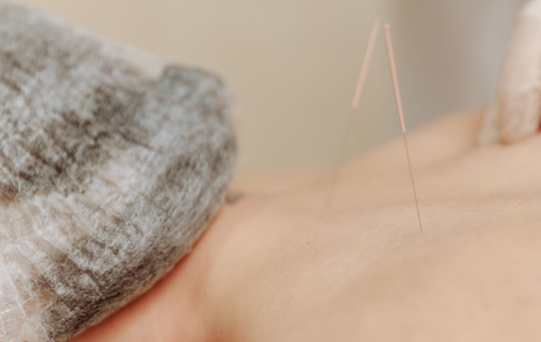 Enhance Health with Acupuncture and Cupping Therapy